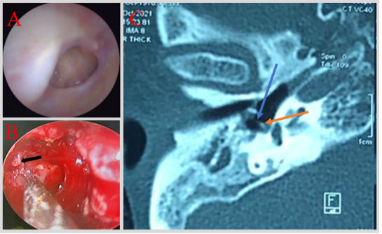 Chỉnh hình chuỗi xương con trong viêm tai giữa mạn tính biến chứng tiêu biến trụ dài xương đe 