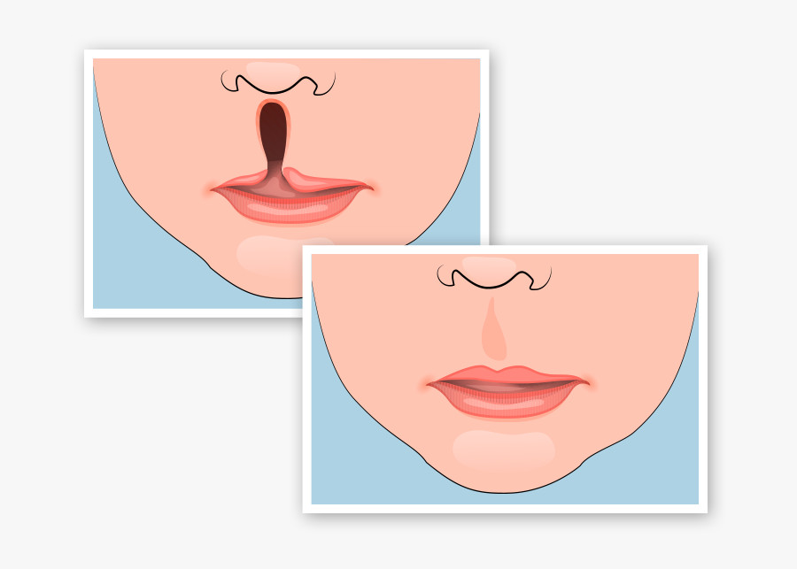 Phẫu thuật tạo hình khe hở môi - vòm miệng trong tình hình dịch COVID-19 ở Bệnh viện Trường Đại học Y Dược Huế