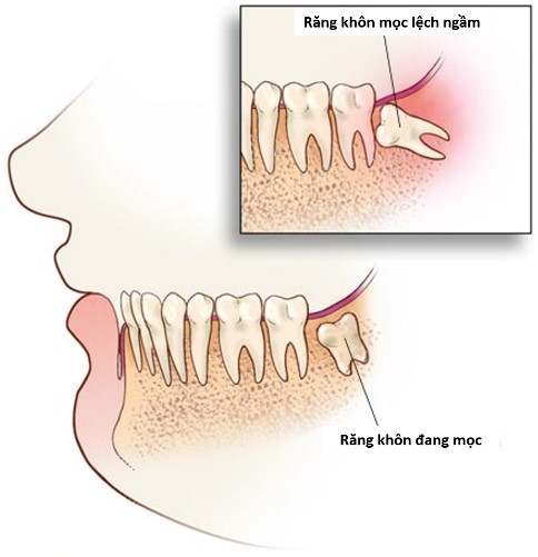 Lợi bị đau nhức có nên nhổ răng khôn không?