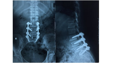 Trượt đốt sống thắt lưng đa tầng do khuyết eo – Thách thức trong phẫu thuật cột sống thắt lưng – Báo cáo 2 trường hợp lâm sàng