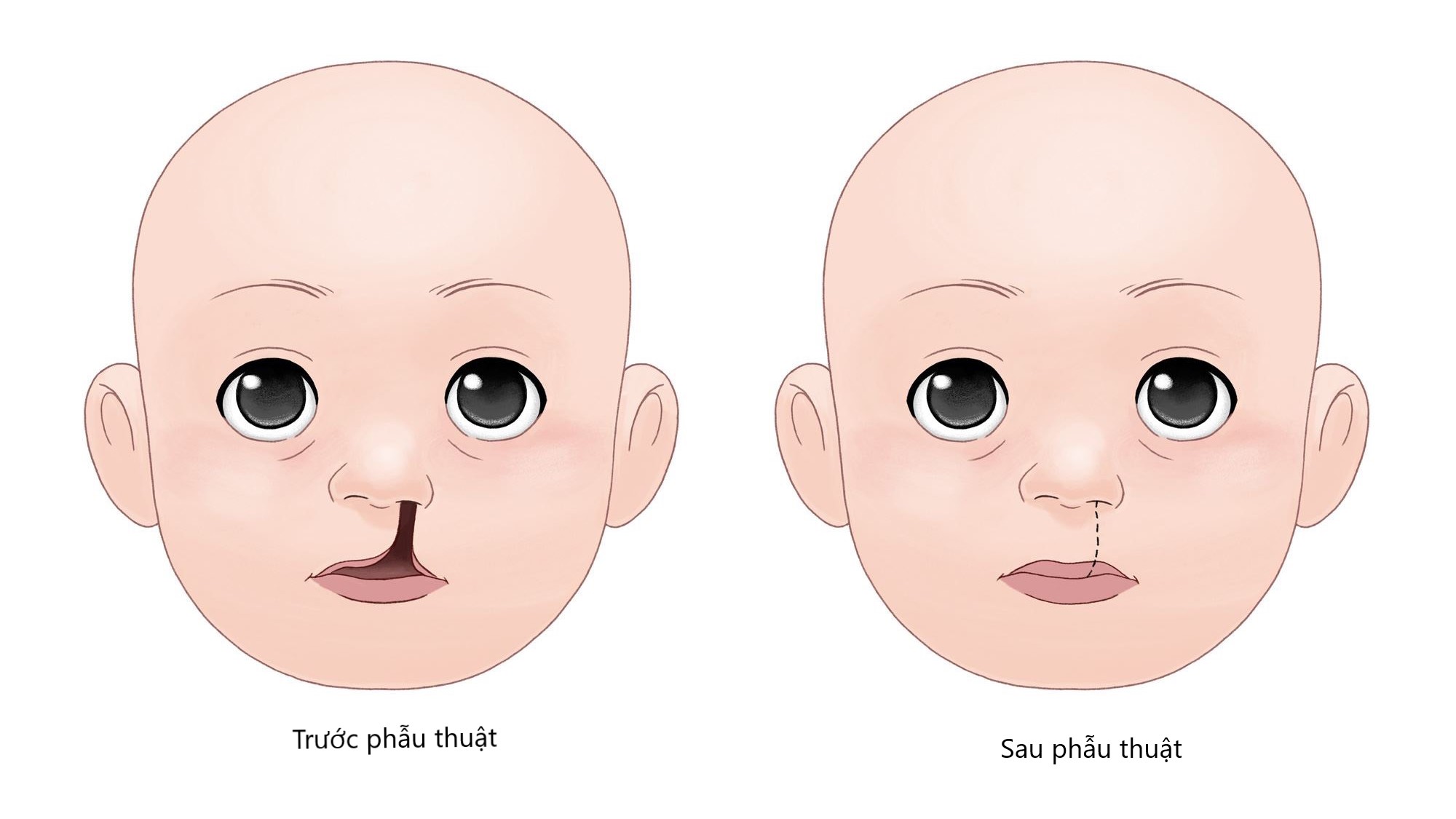 Phẫu thuật tạo hình sớm cho trẻ khe hở môi- vòm miệng ở Bệnh viện Trường Đại học Y Dược Huế