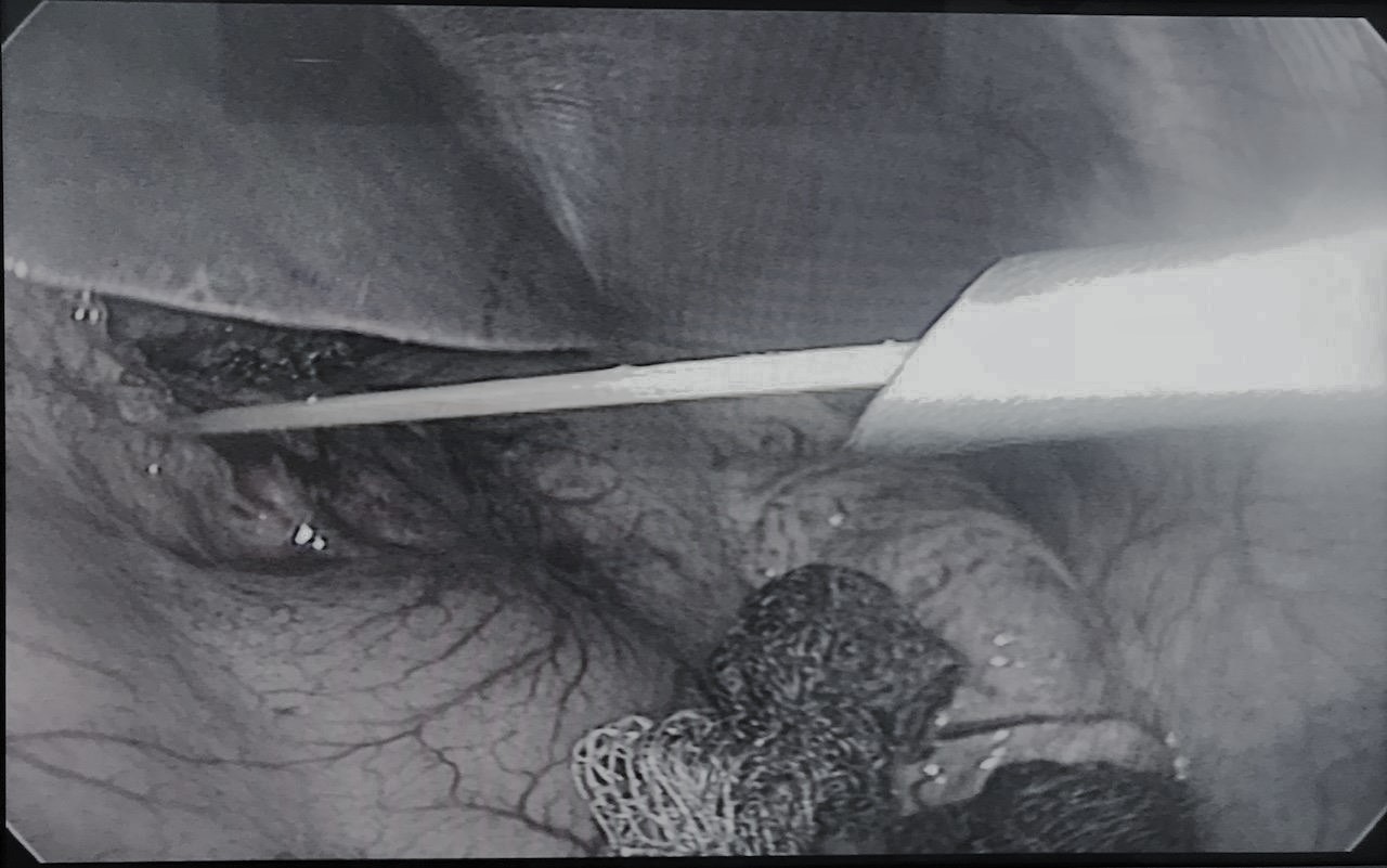 Phẫu thuật nội soi điều trị thành công trường hợp tăm tre xuyên thủng gan trái hiếm gặp